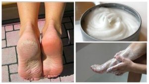وصفة طبيعية مذهلة للتخلص من فطريات، جفاف وتشقق القدمين!