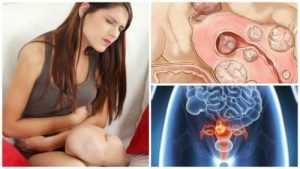 الأورام الليفية الرحمية - 5 حقائق مهمة يجب على كل امرأة معرفتها