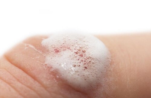 تطهير جرح من خلال البيروكسيد