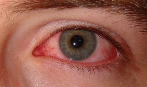 يؤثر القلق على عملية ترطيب العينين الطبيعية