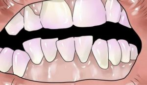 جير الأسنان – علاجات منزلية طبيعية تساعدك على التخلص من جير الأسنان