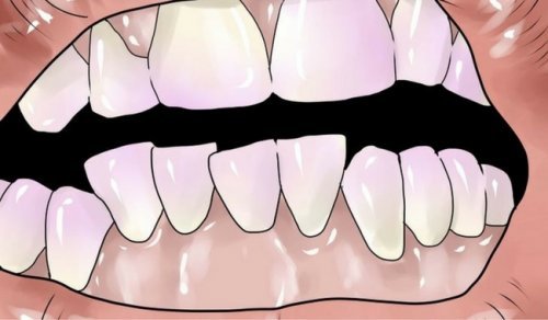 جير الأسنان – علاجات منزلية طبيعية تساعدك على التخلص من جير الأسنان