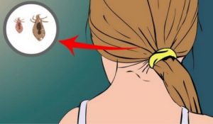 القمل - اكتشف كيف يمكنك التخلص منه باستخدام علاجات طبيعية