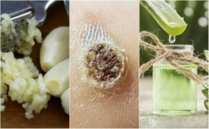 البثور – هل تعاني منها؟ كافح البثور بهذه العلاجات الطبيعية الخمسة