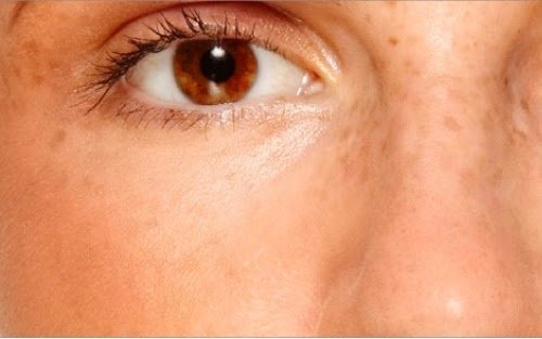 متلازمة تكيس المبايض