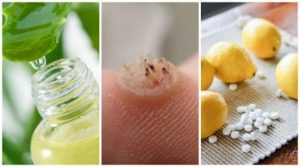 تخلصي من الثآليل باستخدام هذه العلاجات الستة القوية