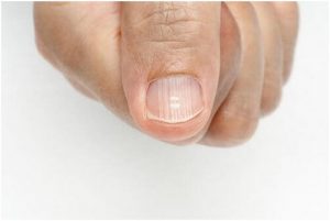 خطوط الأظافر - أسباب ظهورها وكيفية التخلص منها بشكل فعال ونهائي