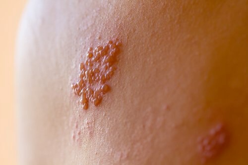 بثور تظهر على الجلد نتيجة مرض القوباء