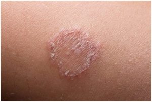 داء السعفة - كل ما تحتاج إلى معرفته عن المرض وكيفية علاجه