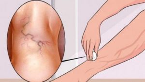 الدوالي - 8 من التمارين الرياضية التي تساعدك على التخلص منها