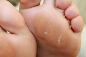 كالو الأصابع – 4 علاجات منزلية طبيعية تساعدك على التخلص منه