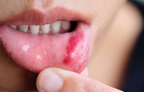 سرطان الفم - أعراضه وعوامل الخطر وأهم الطرق والنصائح للوقاية منه