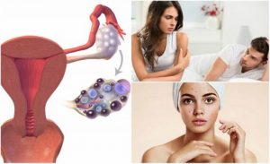 متلازمة تكيس المبايض – 7 أعراض لا يجب تجاهلها أبدًا