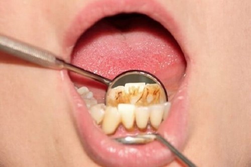تكلس الجير فيما يلي أهم 3 علاجات منزلية فعالة للتخلص من ترسبات الأسنان
