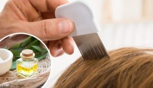 حشرة القمل - 6 علاجات طبيعية فعالة للقضاء على القمل