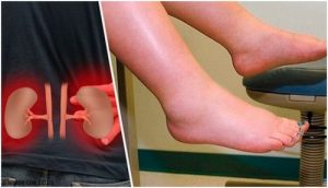 احتباس السوائل - أسباب ظهور الحالة وكيفية التعامل معها