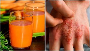 مرض الصدفية - كافح أعراض المرض المزعج بهذه العلاجات الطبيعية السبعة