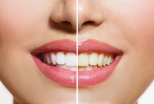 تبييض الأسنان - منتجات طبيعية ستساعدك على تبييض أسنانك