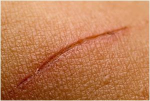 جزء من البشرة وبه جرح في مراحل الإلتئام