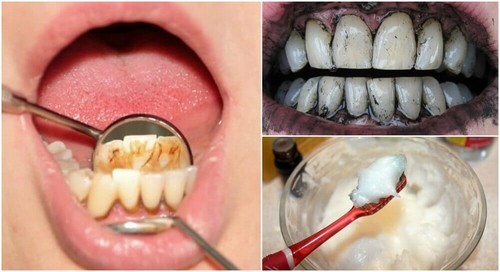 تكلس الأسنان (الجير) – إليك أفضل 3 علاجات منزلية فعالة للتخلص من جير الأسنان