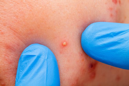 ظهور حب الشباب