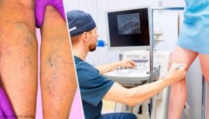 علاجات طبيعية موضعية وفموية لدوالي الأوردة