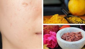 بقع الجلد الداكنة – اكتشفي كيف تكافحينها باستخدام هذه العلاجات طبيعية