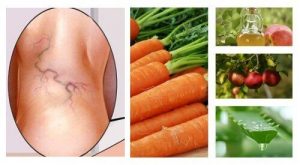 مشكلة دوالي الأوردة – عالجيها بشكل طبيعي باستخدام هذه المكونات الثلاثة