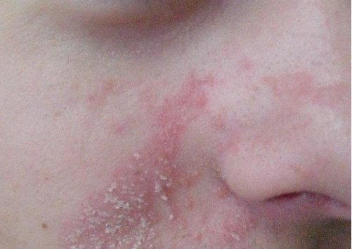 علاج الأكزيما الدهنية