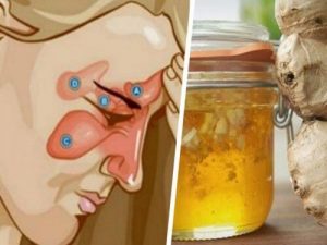 استعن بهذين المكونين لتخفيف التهاب الجيوب الأنفية