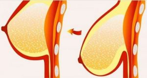 حالة ترهل الثدي - 6 وصايا تساعدك على الحصول على ثديين مشدودين