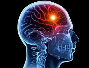 علامات السكتة الدماغية - 8 إشارات تحذيرية يرسلها جسمك قبل الإصابة بالسكتة الدماغية