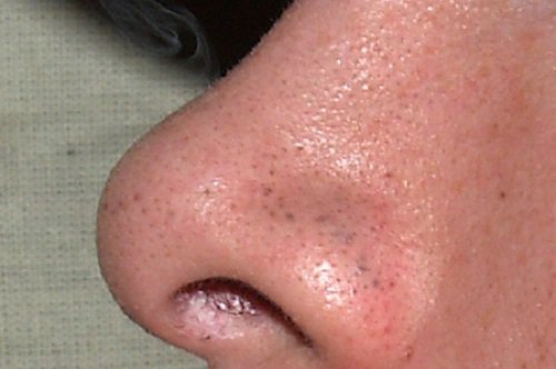 أنف تعاني من الرئوس السوداء