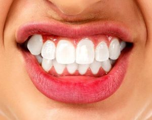 اضطراب صريف الأسنان – اكتشف المزيد حول هذا الاضطراب النفساني الجسماني