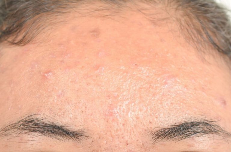 التهاب الجلد الدهني – علاجات طبيعية فعالة لمواجهة الحالة المزعجة