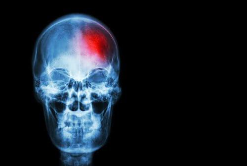 السكتة الدماغية – علامات السكتة الدماغية التي لا يجب تجاهلها أبدًا