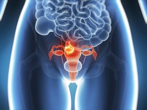 سرطان عنق الرحم – اكتشفي 6 أعراض لا يجب تجاهلها أبدًا