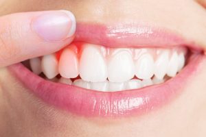 التهابات اللثة - أفضل خمسة علاجات منزلية لعلاج التهابات اللثة بفعالية
