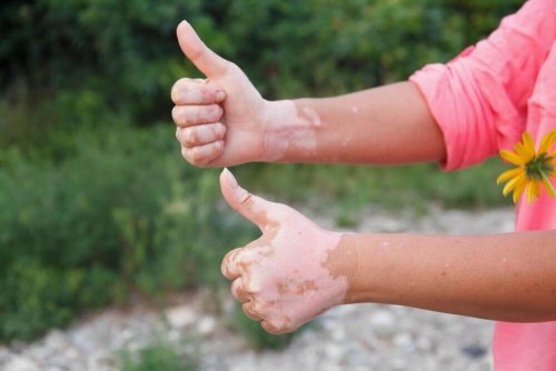 أمراض المناعة الذاتية: أي الأطعمة يجب تناوله وأيها يجب تجنبه