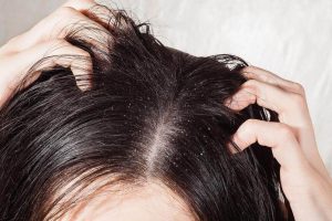 أفضل 6 علاجات لمحاربة فطريات فروة الرأس