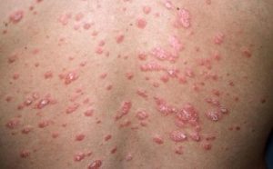 داء الصدفية – ما هي وما هي أنواعها المختلفة؟ وما علاقتها بالاكتئاب؟