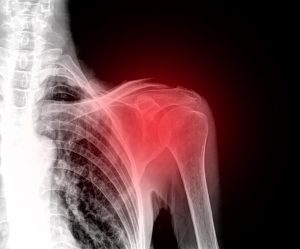 علاجات منزلية من أجل تخفيف ألم الكتف