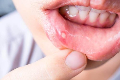 7 علاجات منزلية لعلاج تقرحات الفم