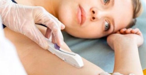 موانع الحمل تحت الجلد