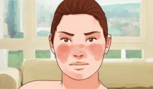 السيطرة على أعراض الذئبة - 7 علاجات طبيعية تساعدك على مواجهة الحالة