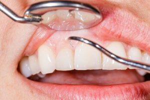 مشكلة تورم اللثة - 7 حلول طبيعية لمكافحة أعراض تورم اللثة