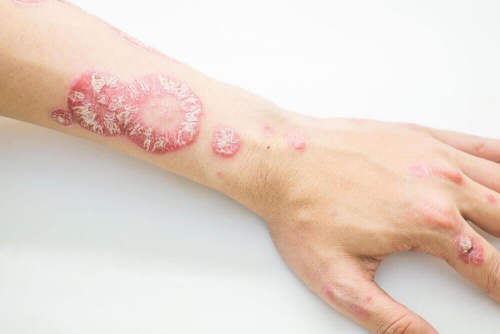 داء صدفية الجلد – تغلب على الصدفية بواسطة هذه العلاجات الطبيعية