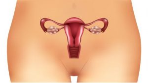 أعراض متلازمة المبيض متعدد الكيسات (PCOS) غير المعروفة