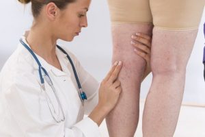 حالة احتباس السوائل - 4 علاجات طبيعية لاحتباس السوائل في الجسم
