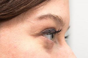 الأكياس الدهنية تحت العينين - المسببات ووسائل العلاج الطبيعية